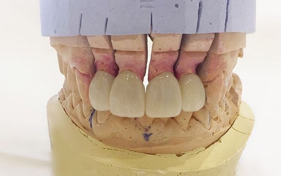 Modello Dentale Resina Base Acqua